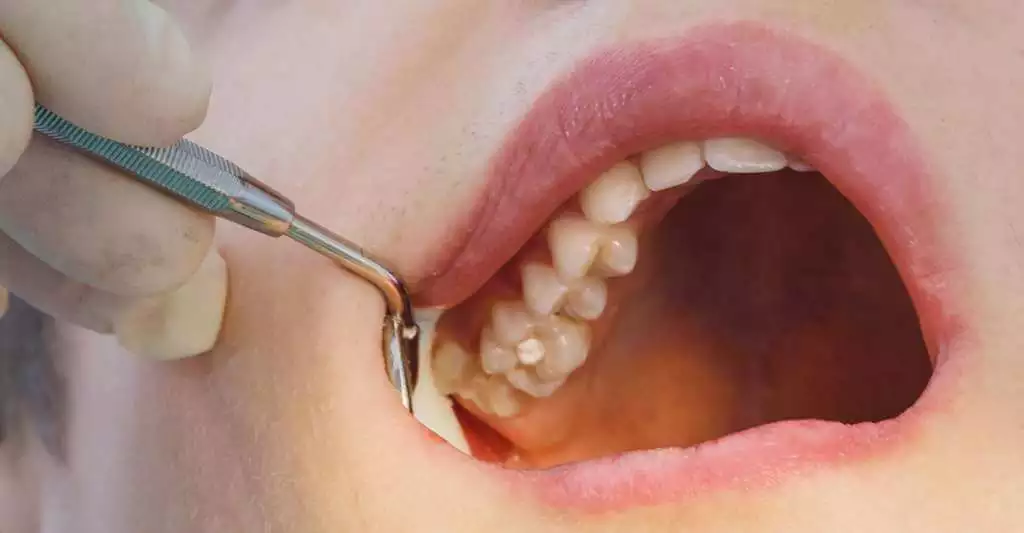 Soins Caries
